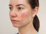 Rosacea Treatment